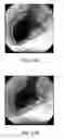 Fig. 35 - Cartridge and method for increasing myocardial function