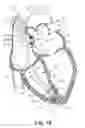 Fig. 20 - System and method for rate modulated cardiac therapy utilizing a temperature senor