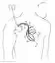 Fig. 01 - Method and medical device for discriminating between a supraventricular tachycardia and a ventricular tachycardia