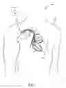 Fig. 02 - Method and medical device for discriminating between a supraventricular tachycardia and a ventricular tachycardia
