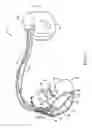 Fig. 03 - Method and medical device for discriminating between a supraventricular tachycardia and a ventricular tachycardia