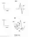 Fig. 16 - Method and medical device for discriminating between a supraventricular tachycardia and a ventricular tachycardia