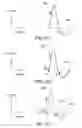 Fig. 17 - Method and medical device for discriminating between a supraventricular tachycardia and a ventricular tachycardia