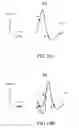Fig. 20 - Method and medical device for discriminating between a supraventricular tachycardia and a ventricular tachycardia