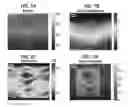 Fig. 08 - Method and apparatus to measure tissue displacement and strain