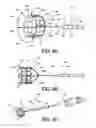 Fig. 04 - Adjustable Heart Valve Implant