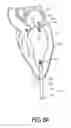 Fig. 08 - Adjustable Heart Valve Implant