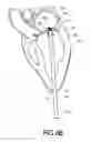 Fig. 09 - Adjustable Heart Valve Implant