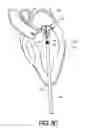 Fig. 22 - Adjustable Heart Valve Implant