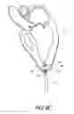 Fig. 28 - Adjustable Heart Valve Implant