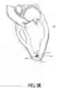 Fig. 30 - Adjustable Heart Valve Implant