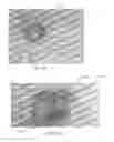 Fig. 18 - Devices and methods for the treatment of vascular defects