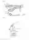 Fig. 09 - Surgical trabecular tool and method for manufacturing