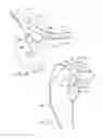Fig. 06 - Patient specific glenoid guide