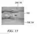 Fig. 10 - CLOT RETRIEVAL SYSTEM