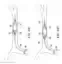 Fig. 48 - CLOT RETRIEVAL SYSTEM