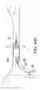 Fig. 49 - CLOT RETRIEVAL SYSTEM