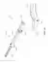 Fig. 12 - Surgical instrument with removable portion to facilitate cleaning