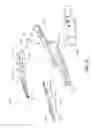 Fig. 32 - Surgical instrument with removable portion to facilitate cleaning