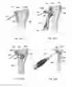 Fig. 30 - Wrist stabilization systems