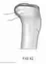 Fig. 65 - Arthroplasty jigs with mating accuracy