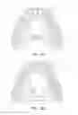Fig. 05 - IMPLANT AND DELIVERY SYSTEM FOR NEURAL STIMULATOR