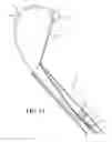 Fig. 16 - Capsular tension ring inserter and method