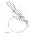 Fig. 28 - Capsular tension ring inserter and method
