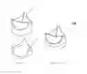 Fig. 12 - Heart valve bioprosthesis and manufacturing method thereof