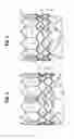 Fig. 03 - Prosthetic heart valve having leaflet inflow below frame