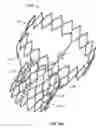 Fig. 24 - Stent features for collapsible prosthetic heart valves