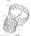 Fig. 27 - Stent features for collapsible prosthetic heart valves
