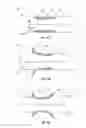 Fig. 06 - Cardiac implant delivery system