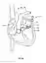 Fig. 19 - Cardiac implant delivery system