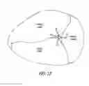 Fig. 19 - Fixation devices, systems and methods for heart valve leaf repair