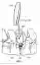 Fig. 02 - Methods and apparatus for facilitating a posterior lumbar interbody fusion procedure