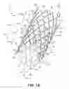 Fig. 02 - Stent