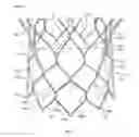 Fig. 02 - Methods of repositioning a transcatheter heart valve after full deployment