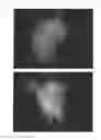 Fig. 43 - C-type natriuretic peptide agent for the treatment of alopecia