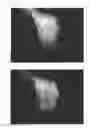 Fig. 45 - C-type natriuretic peptide agent for the treatment of alopecia
