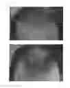 Fig. 49 - C-type natriuretic peptide agent for the treatment of alopecia