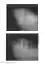 Fig. 52 - C-type natriuretic peptide agent for the treatment of alopecia