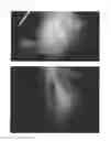 Fig. 63 - C-type natriuretic peptide agent for the treatment of alopecia