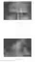 Fig. 02 - Self-administered injection device and method