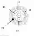 Fig. 01 - Balloon dilation assembly