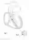 Fig. 06 - Balloon dilation assembly