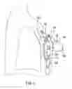 Fig. 06 - Pleural space draining assembly