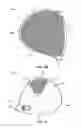 Fig. 07 - High density outer layer of a golf club head