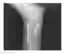 Fig. 01 - Metal artifacts reduction for cone beam CT