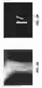 Fig. 04 - Metal artifacts reduction for cone beam CT